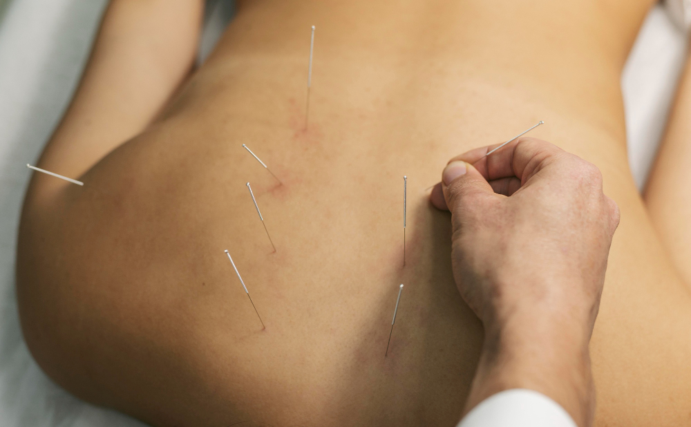 Dry Needling